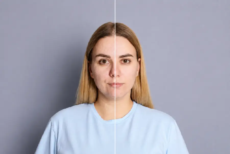 peeling químico facial en Lima