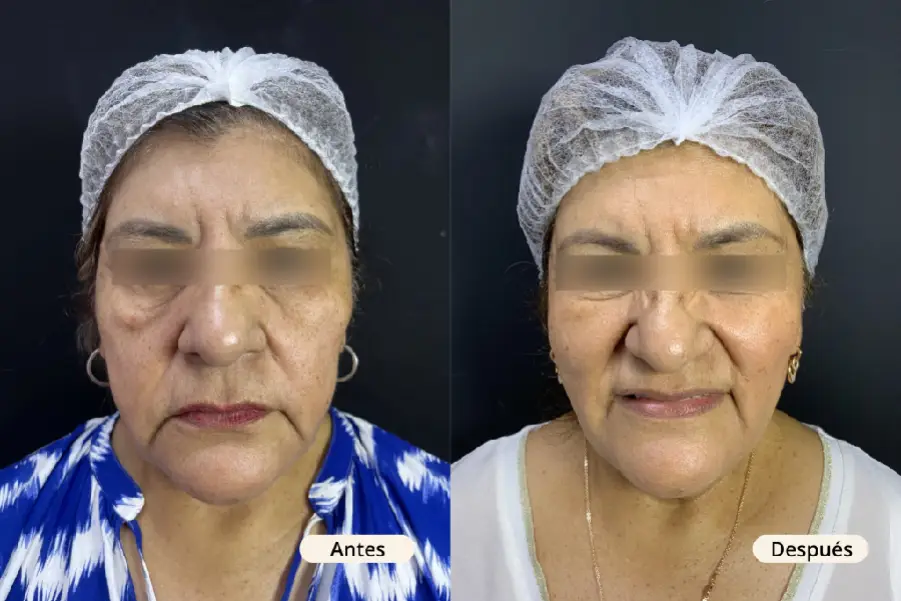 tratamiento para manchas faciales