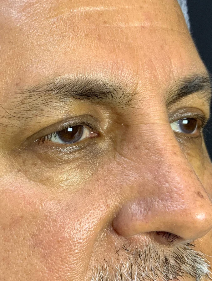 Protocolo Aclaramiento de Ojeras - Antes