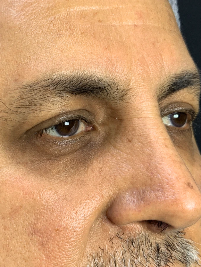 Protocolo Aclaramiento de Ojeras - Antes