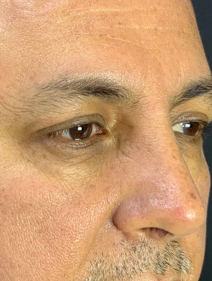 Protocolo Aclaramiento de Ojeras - Después