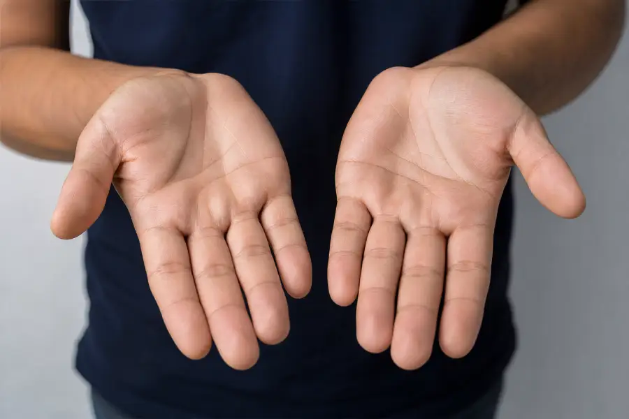 Botox para hiperhidrosis en manos