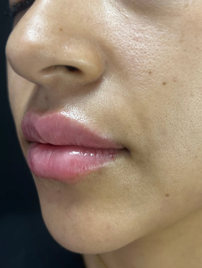 Armonización labial - Después